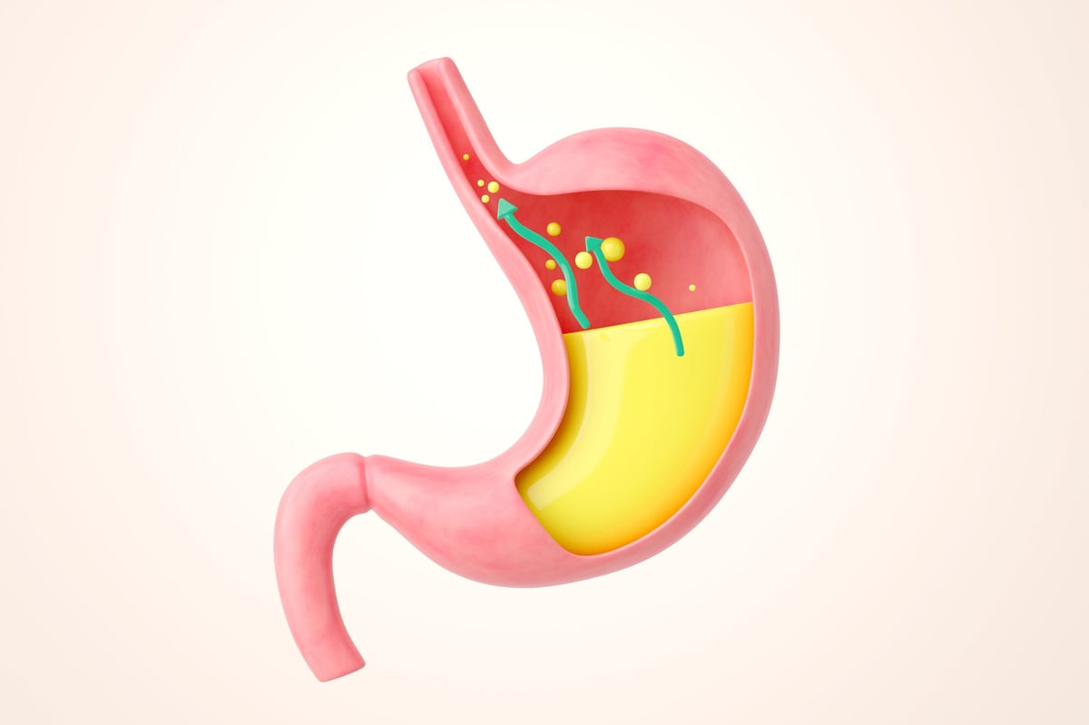 Reflujo ácido y acidez estomacal